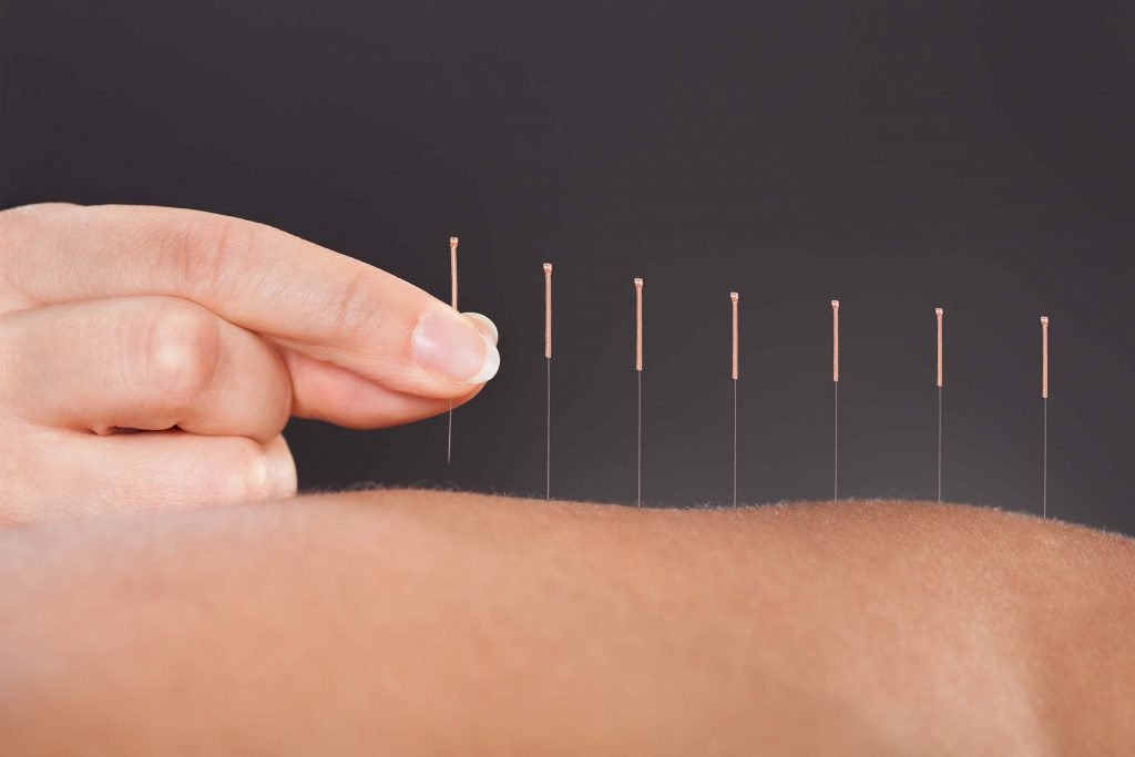 acupuncture
